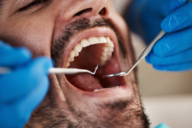 Best Emergency Dentist for Lost Fillings or Crowns in Harvey, MI