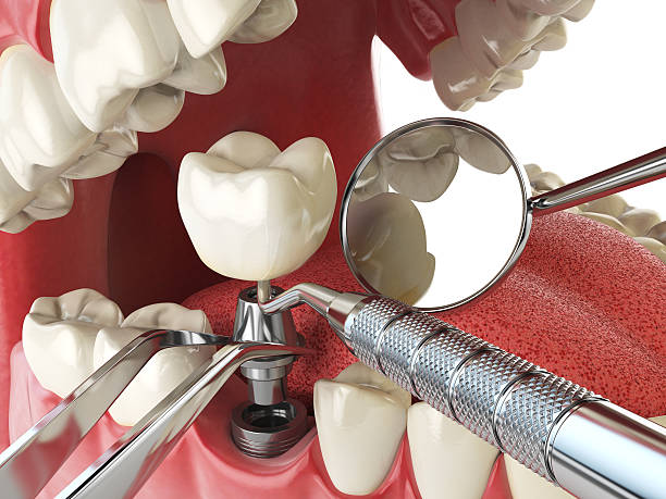 Best Emergency Dental Extractions in Harvey, MI